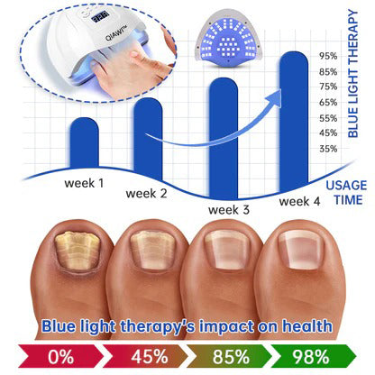 🔥 Father's Day Sale👏QIAWI™ PureNail Fungus Laser Device-✨Last Day Discount -50%𝐎𝐅𝐅