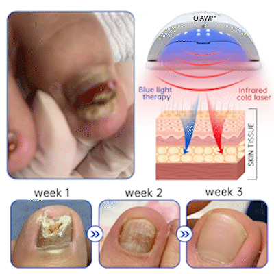 🔥 Father's Day Sale👏QIAWI™ PureNail Fungus Laser Device-✨Last Day Discount -50%𝐎𝐅𝐅