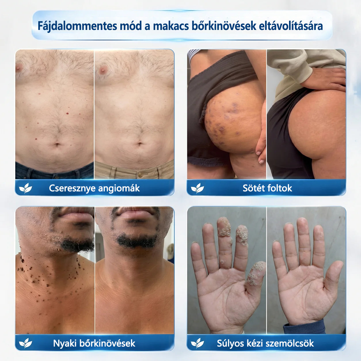 Hivatalos áruház | CleraNaure® 7 napos pigmentfolt- és bőrhiba-eltüntető kezelés (Fájdalommentes, hegmentes görgős applikátor)