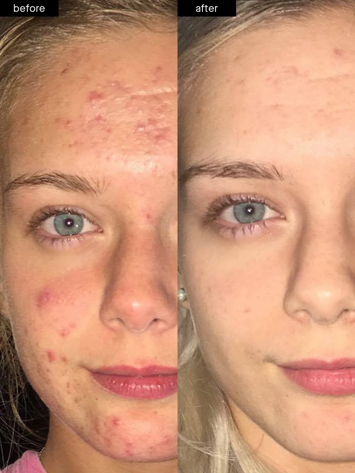 Acne System - Standard Kit (60-Day) by SLMD Skincare