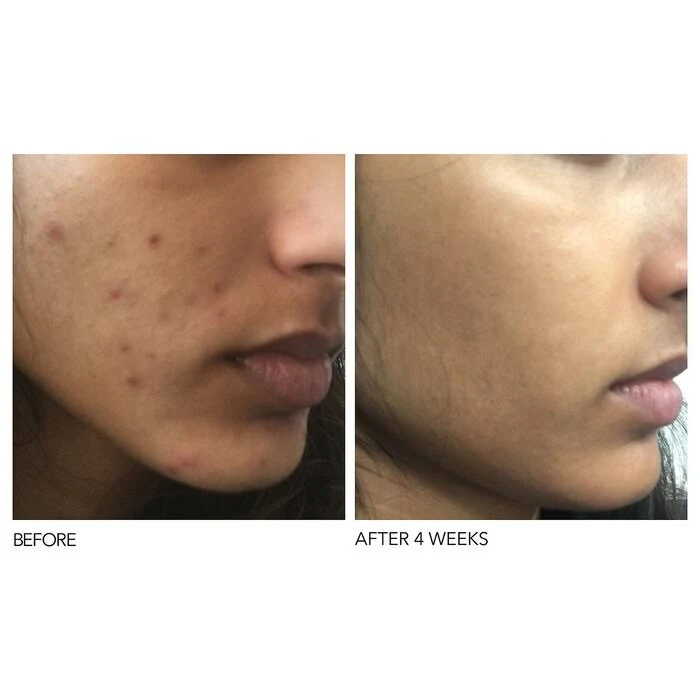 Dr. Dennis Gross Skincare Alpha Beta Extra Strength Daily Peel 60 Treatments
