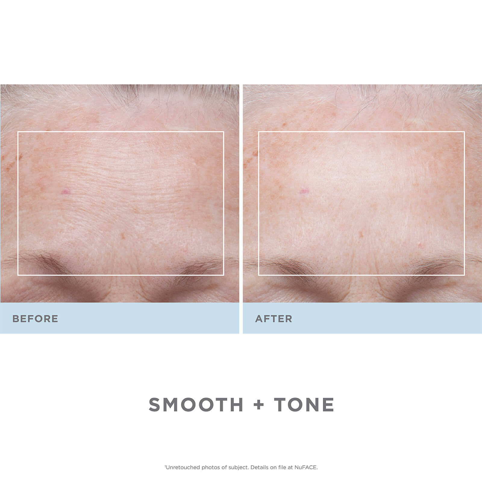 Nuface Trinity Facial Toning Device + Wrinkle Reducer Attachment Bundle