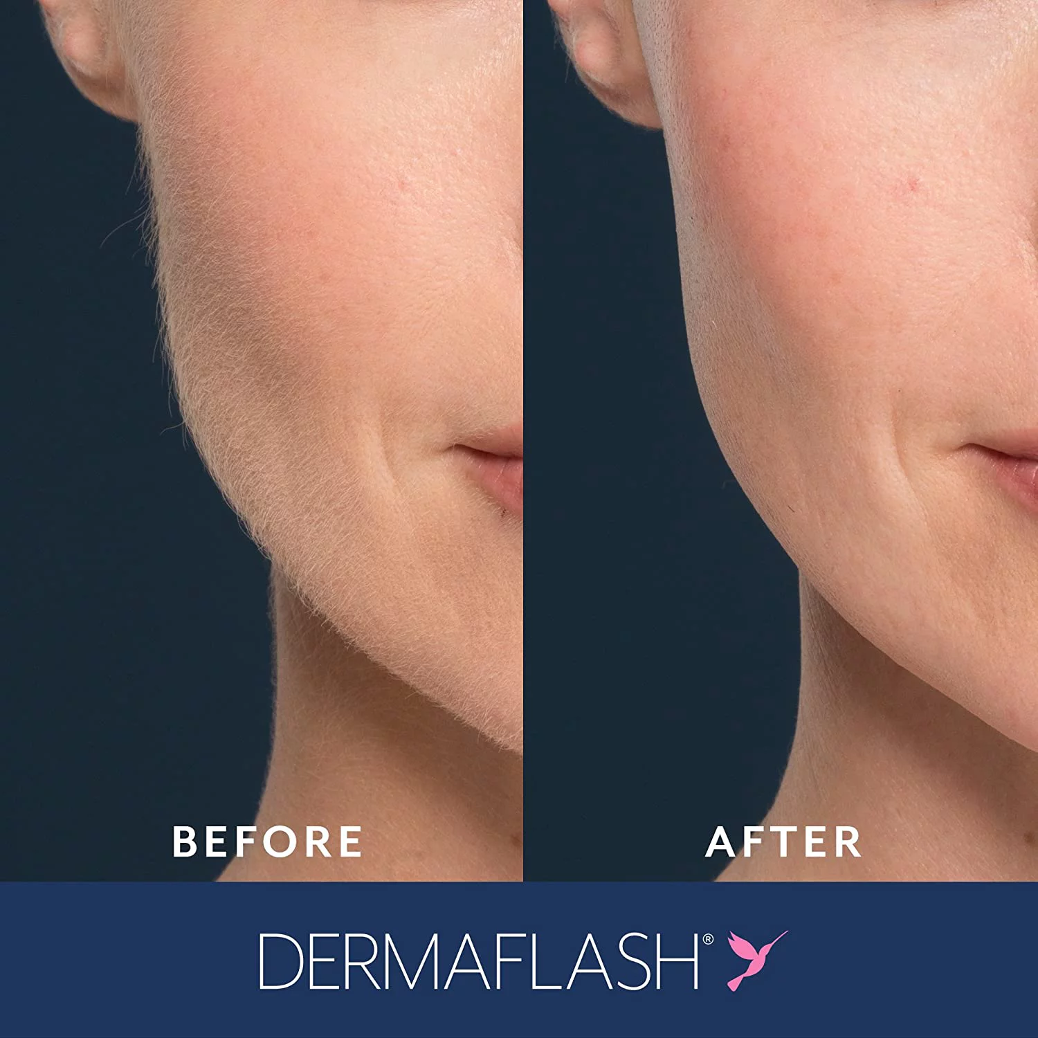 DERMAFLASH LUXE Device Exfoliating, Hair Removal (Icy Pink)