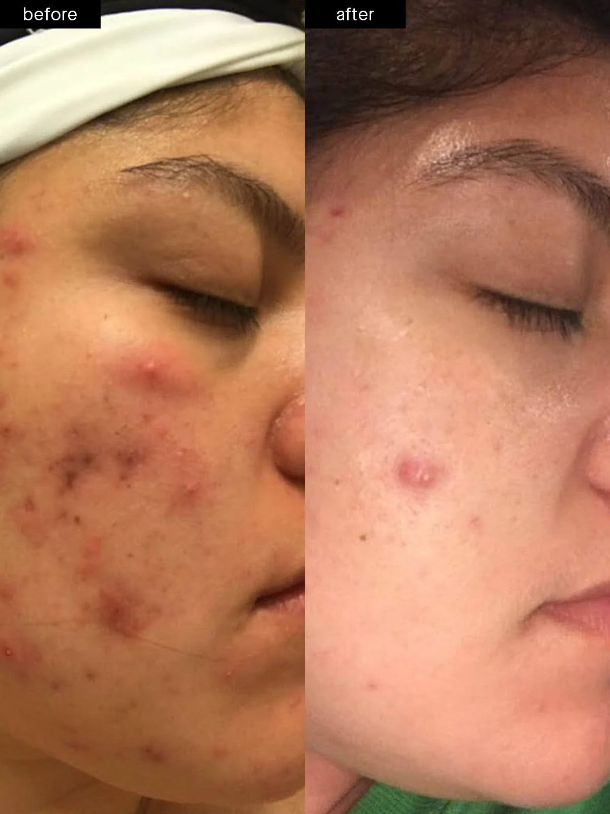 Acne System - Standard Kit (60-Day) by SLMD Skincare