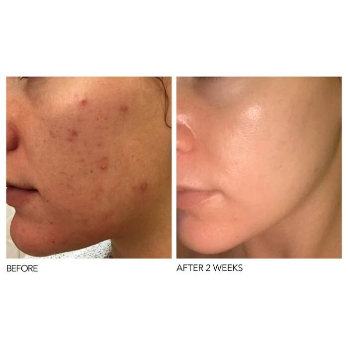 Dr. Dennis Gross Skincare Alpha Beta Extra Strength Daily Peel 60 Treatments
