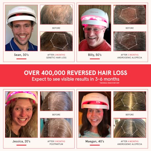 iRestore Essential Laser Hair Growth System - FDA Cleared Hair Growth for Men & Hair Loss Treatments for Women with Thinning Hair, Hair Regrowth for Women