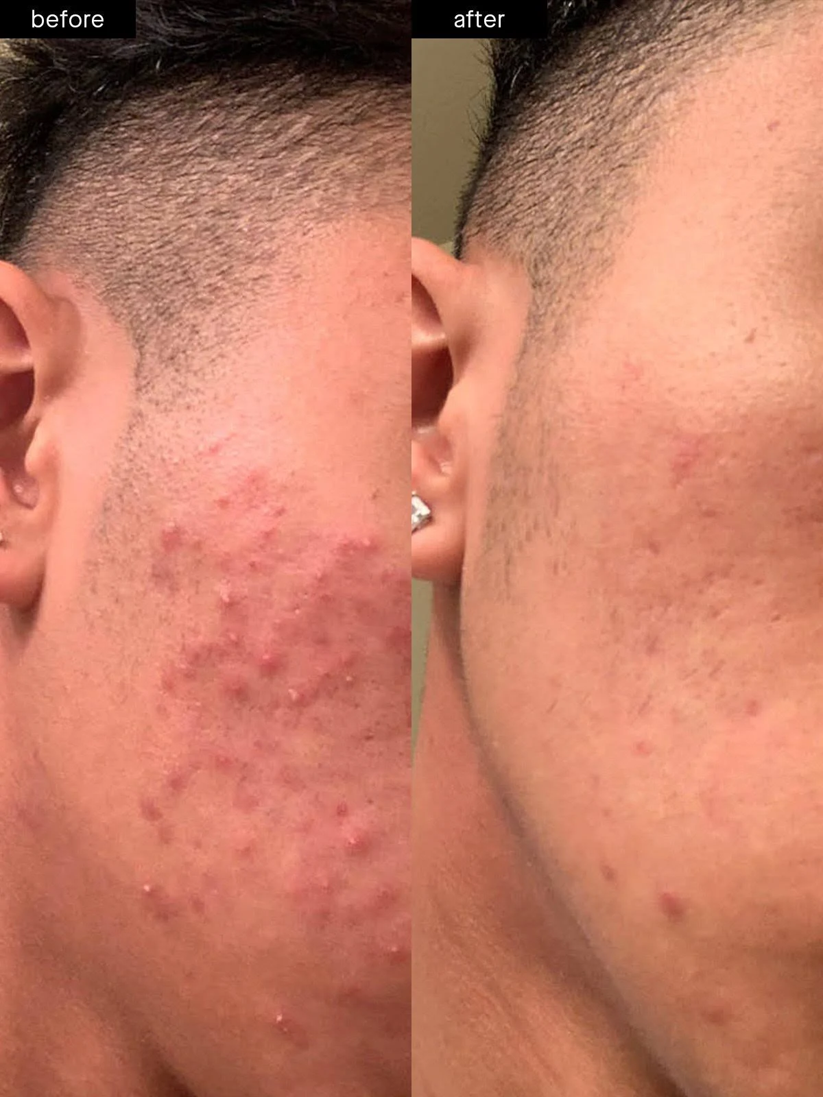 Acne System - Standard Kit (60-Day) by SLMD Skincare