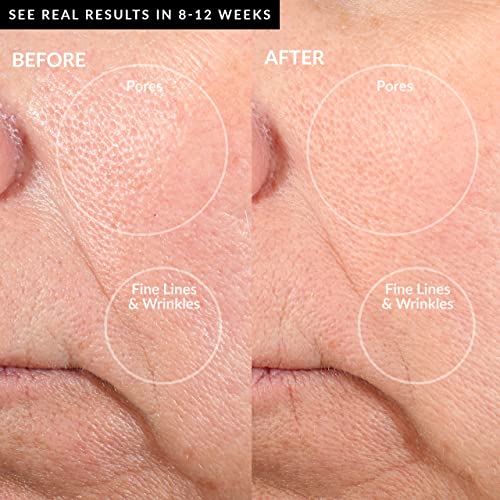 PMD Personal Microderm Pro - At-Home Microdermabrasion Machine with Kit for Face & Body - Exfoliating Crystals and Vacuum Suction for Fresh and Radiant Skin - High & Low Speed Options