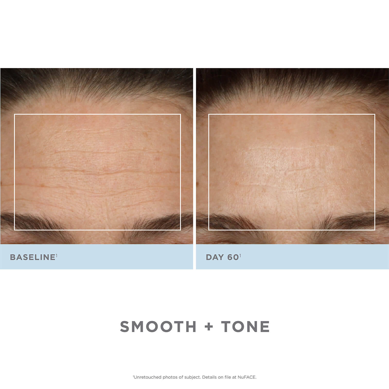 Nuface Trinity Facial Toning Device + Wrinkle Reducer Attachment Bundle