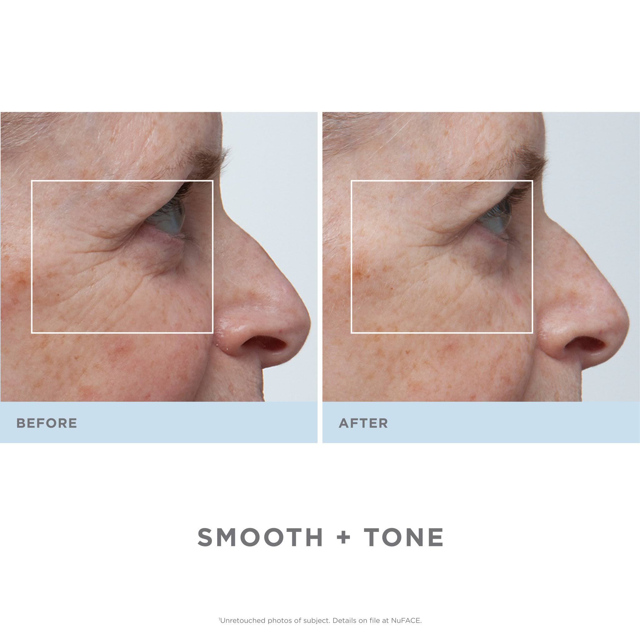 NuFACE Trinity Facial Trainer Kit with Wrinkle Reducer Attachment, White