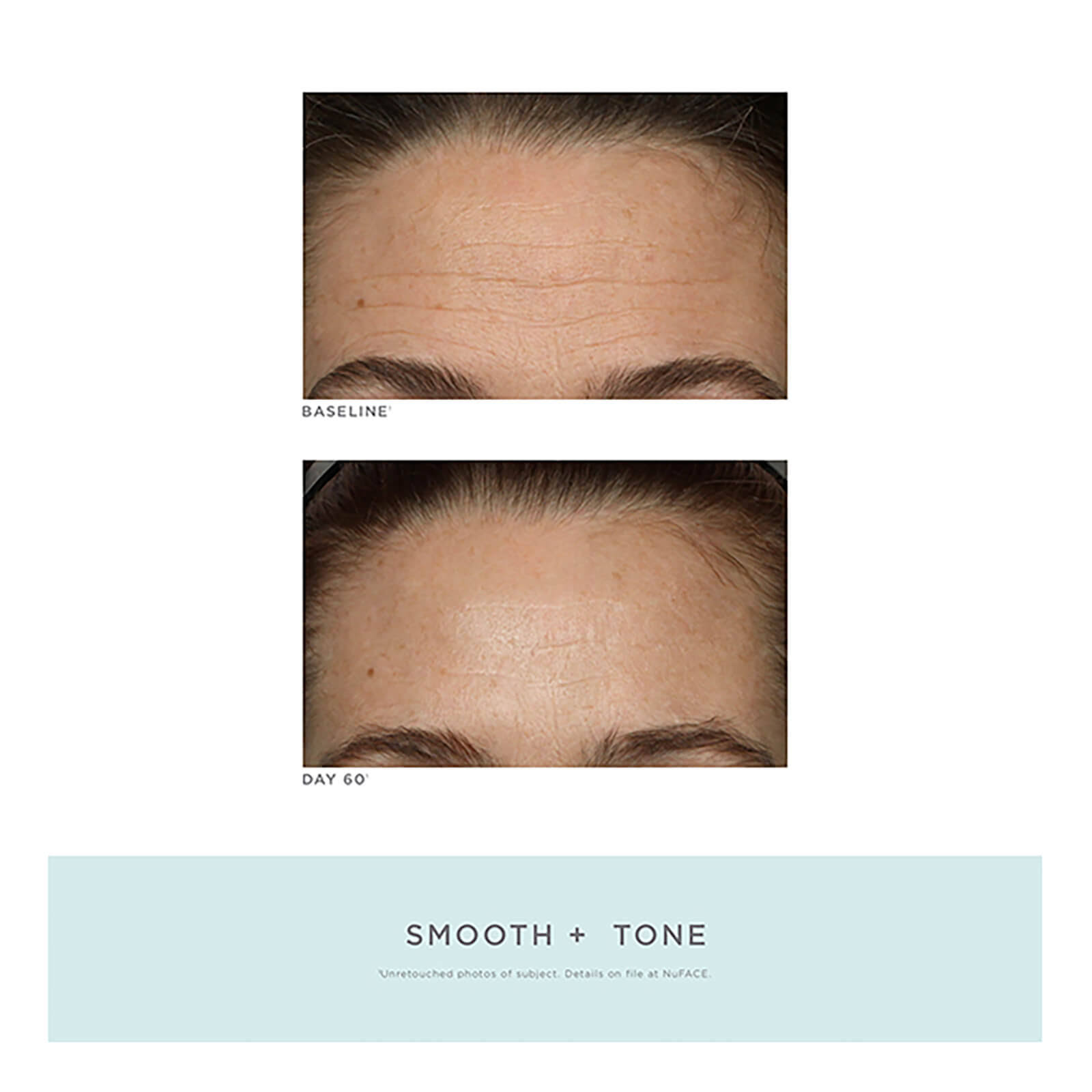 Nuface Trinity Facial Toning Device + Wrinkle Reducer Attachment Bundle