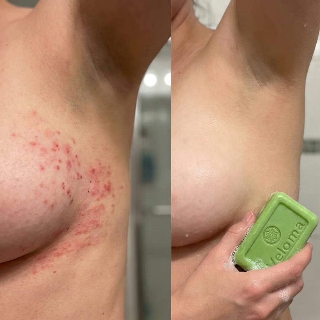 Veloma-Antifungal Soap®