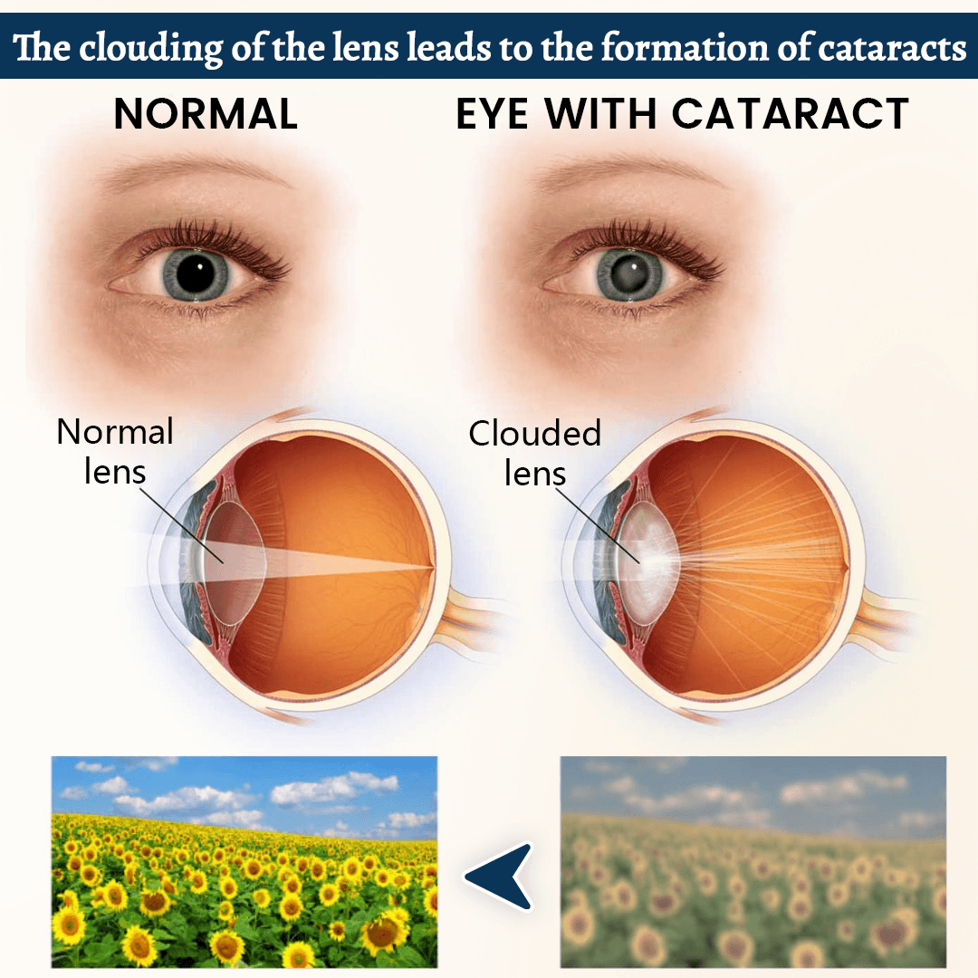 OptiFusion Vision Support Eye Patch