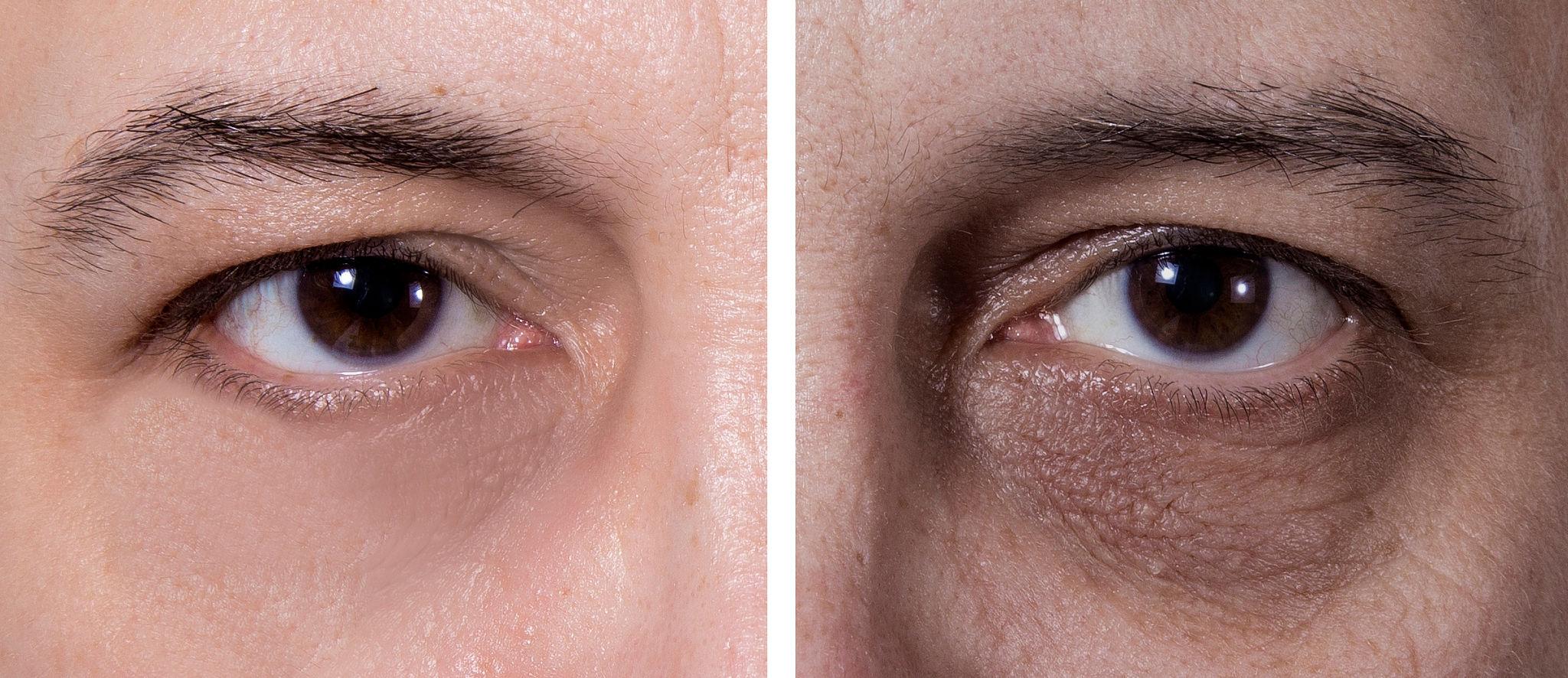 Dark eye circles treatment - BEFORE and AFTER