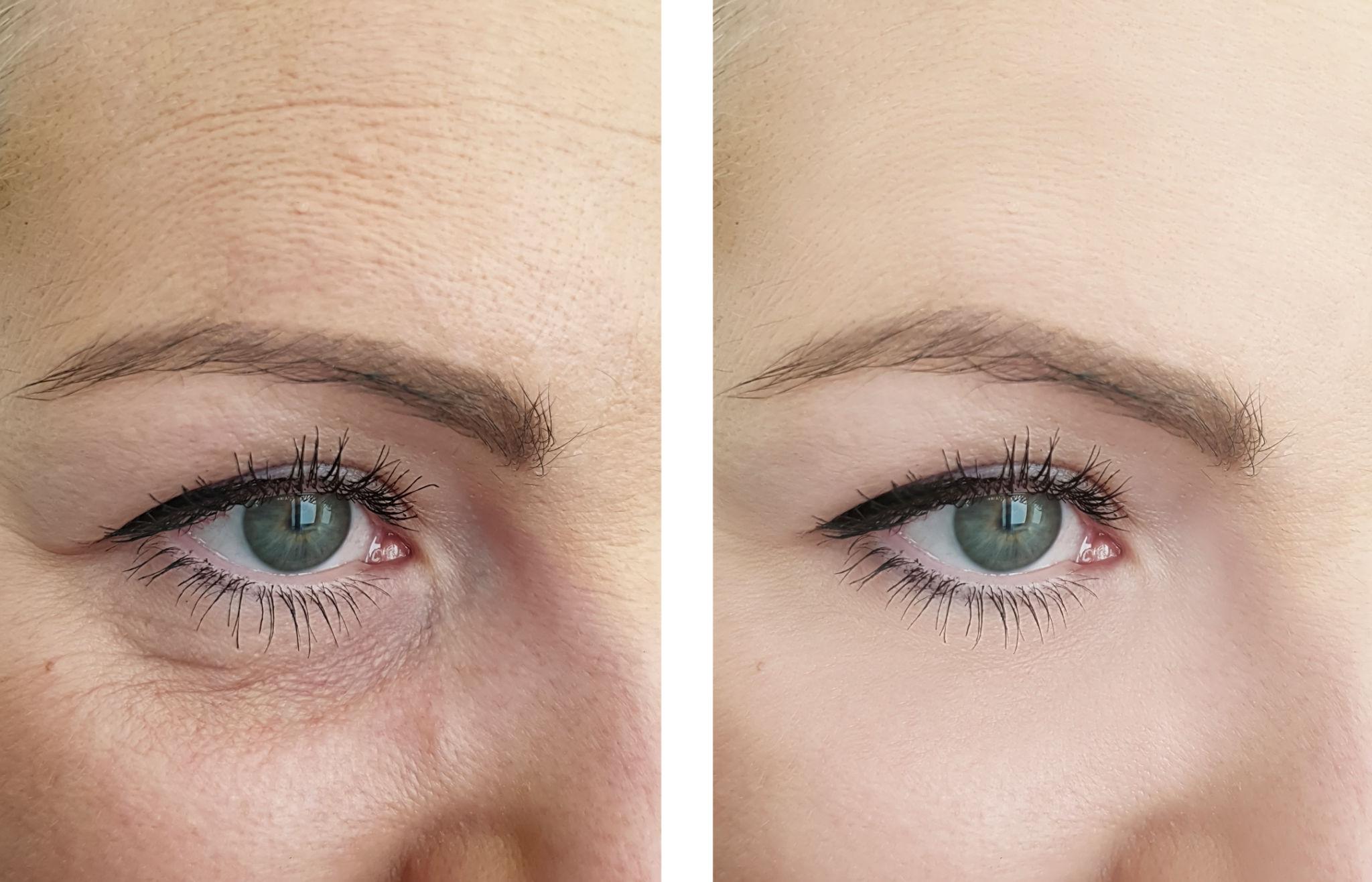woman wrinkles face before and after treatments