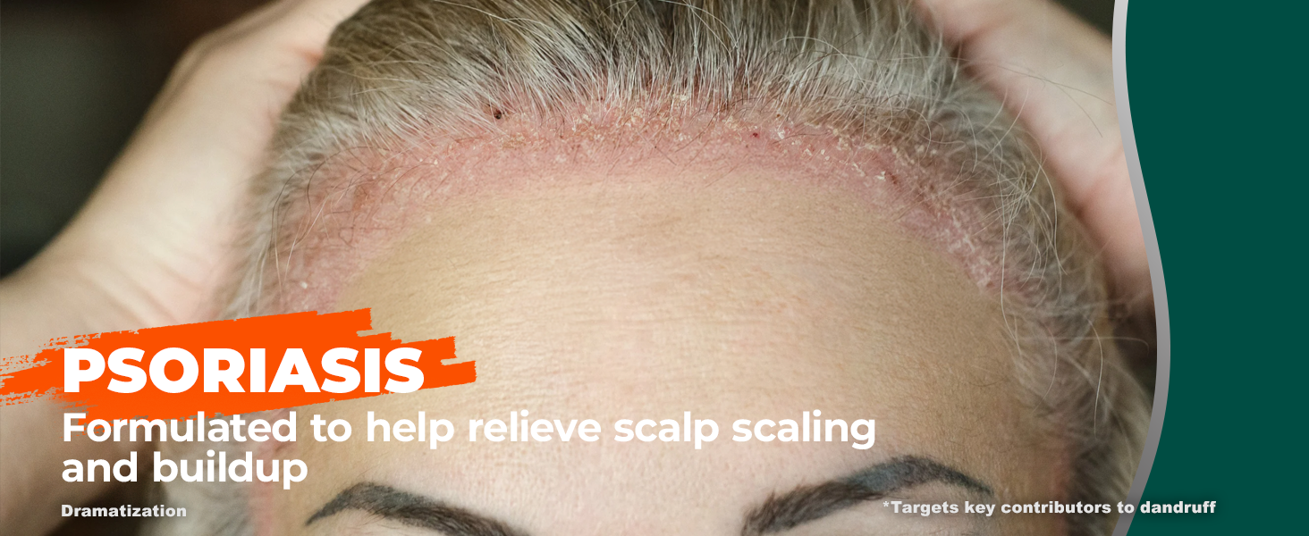 Psoriasis shampoo for scalp scaling and buildup, close-up of hairline with psoriasis flakes