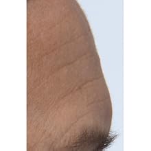 Peter Thomas Roth, Potent-C Power Serum, forehead, before