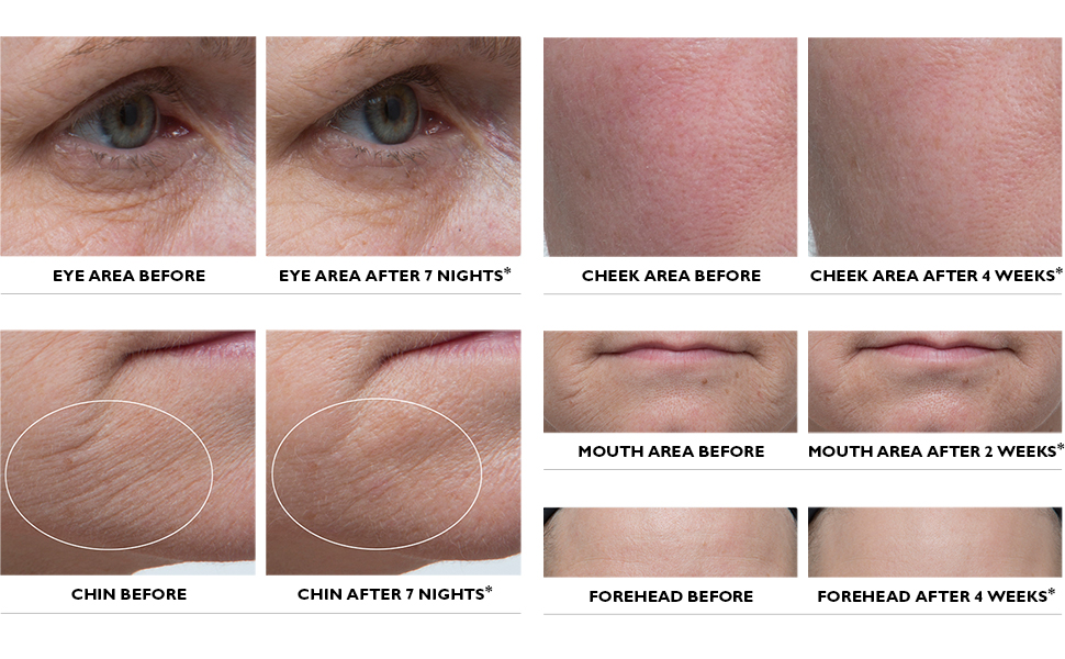 Peter Thomas Roth, Retinol Fusion PM Night Serum, before and after, B&amp;A
