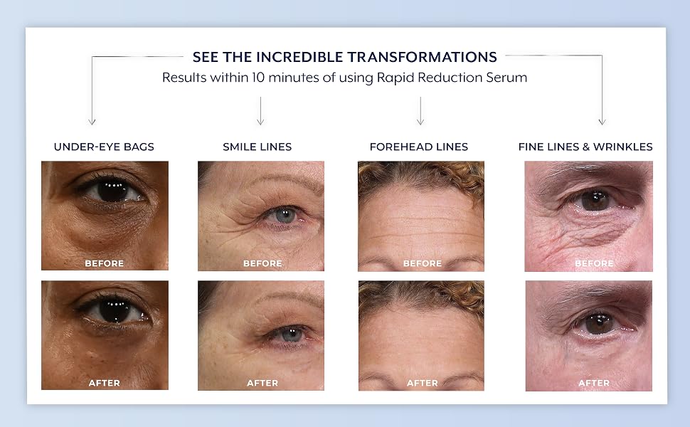 under-eye bags, smile lines, forehead lines, fine linew and wrinkles