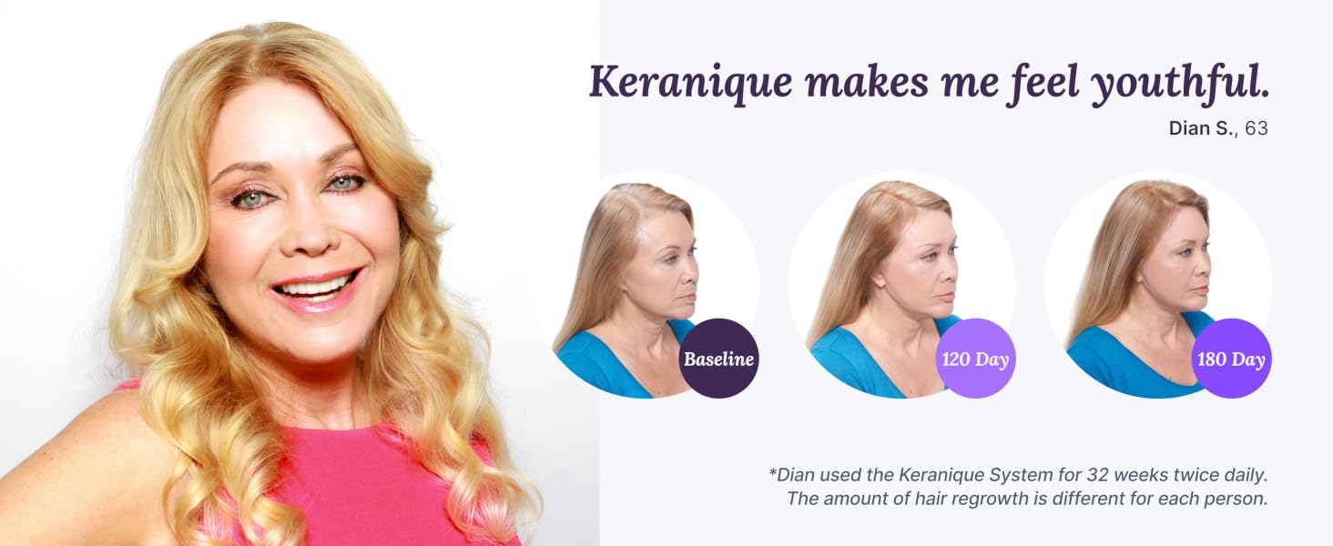 Hair regrowth transformation of an older woman who used Keranique system to stop hair thinning