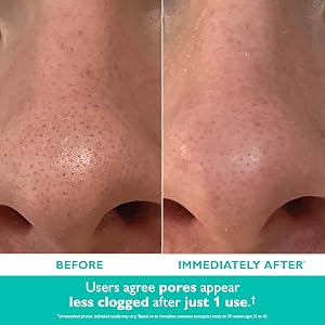 even smoother, microdermabrasion Exfoliating Pore Purifier, results, before and after, b&amp;a
