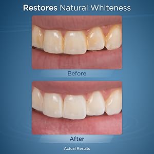 whiten teeth whitening brighter