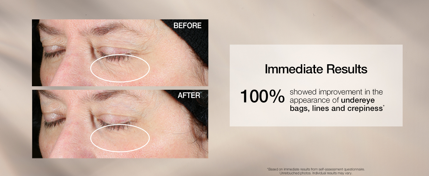 Hyperlift Eye
