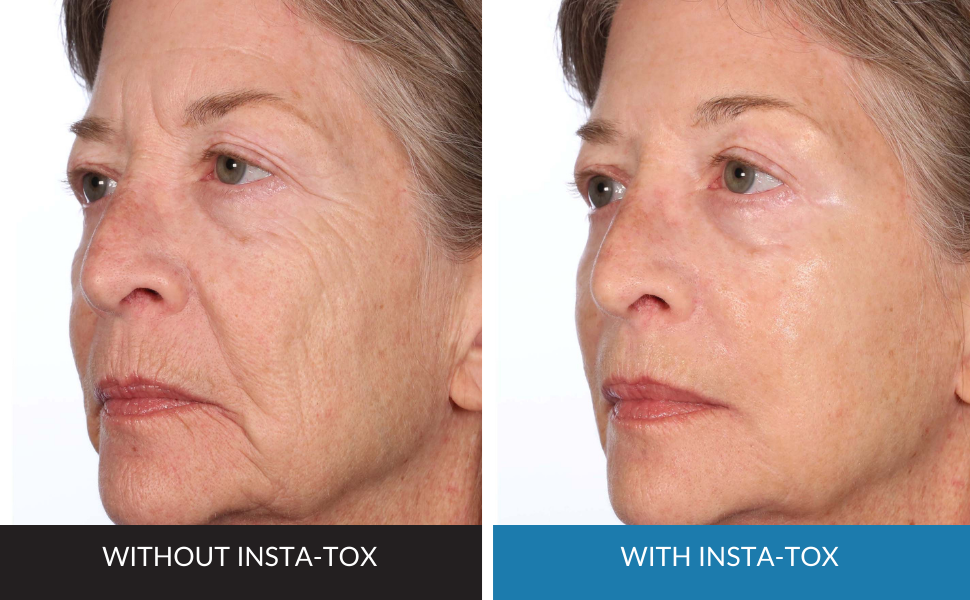 Image of womans face shows before and after insta tox, fewer visible lines and wrinkles