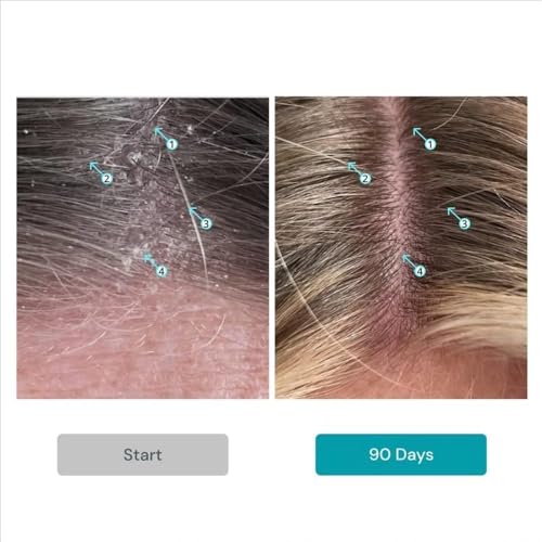 DS Labs Dandrene Anti-Dandruff Shampoo & Conditioner Kit, 205 mL | Complete scalp care system with Nanosome Technology & aloe vera to cleanse