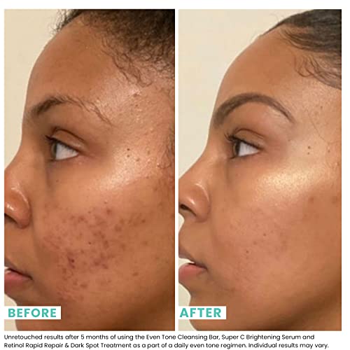 Urban Skin Rx Even Tone Cleansing Bar | 3-in-1 Multitasking Treatment Daily Cleanser, Exfoliator