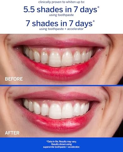 Supersmile Professional Whitening System, Toothpaste + Accelerator, 4.2 Oz | 2-Step Calprox® System, Whitens Up to 7 Shades in 7 Days