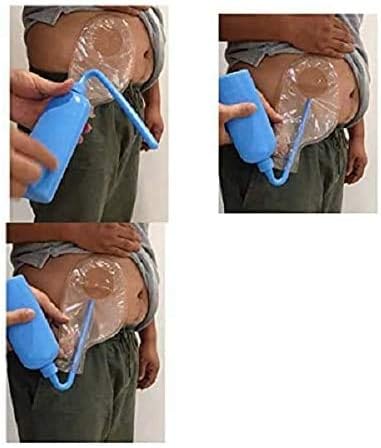 Colostomy Bag Cleaning Tool - Stoma Bag Washing Bottle Rinse Pot for All Ostomy Bags - Reusable Wash Bottle (1PCS PZ)