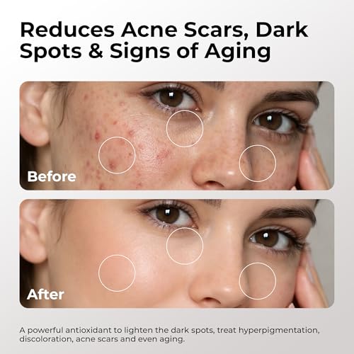 Skin Deva 20% Vitamin C Serum Anti Aging with Hyaluronic Acid & Vitamin E Ferulic Acid - Brightening Formula for Improving Appearance of Dark Spots, Fine Lines & Wrinkles - All Skin Types, 1 fl oz