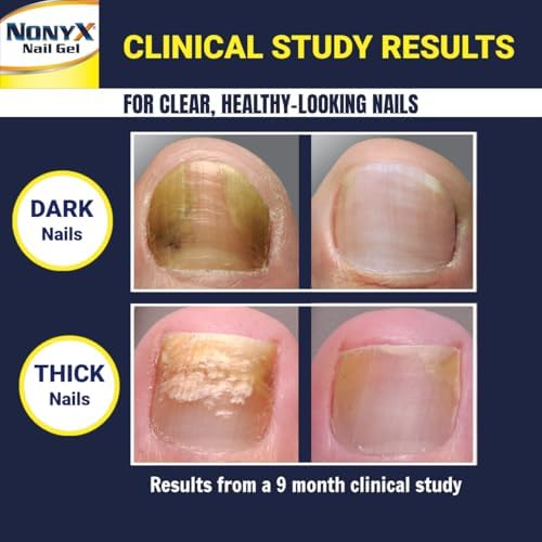 NONYX Fungal Nail Clarifying Gel | Clinically Proven for Discolored, Thick, Brittle, Yellow, Lifted