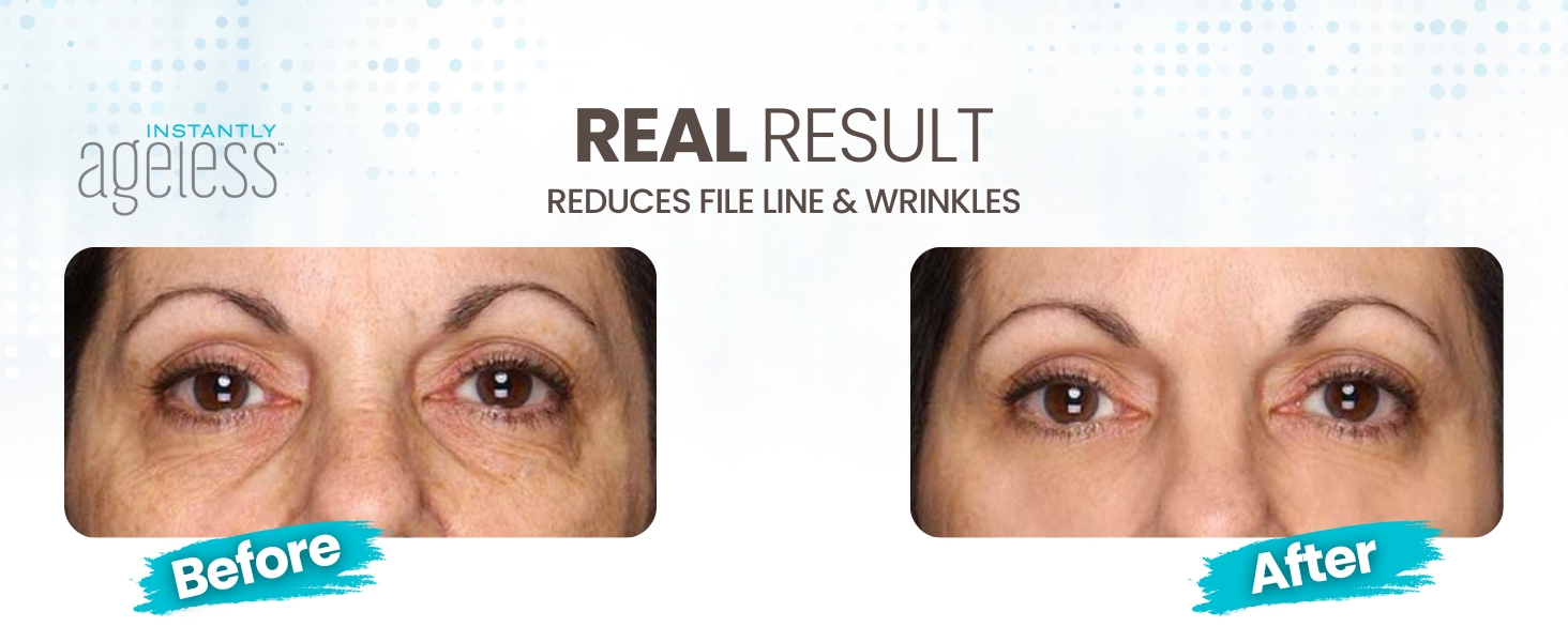 eyebag remover image ageless hyaluronic filler instant tightening face lift facelift and eye lift