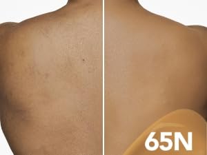 HYPERPIGMENTATION