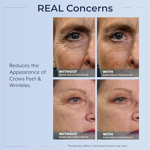Plexaderm Eye Serum, 30 Single Use Pods - Visibly Reduces Bags & Wrinkles