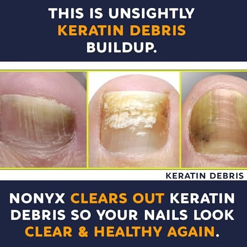 NONYX Fungal Nail Clarifying Gel | Clinically Proven for Discolored, Thick, Brittle, Yellow, Lifted