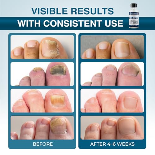 FUNGINIX Toenail Fungus Treatment Extra Strength - Antifungal Nail Treatment With 10% Undecylenic Acid & Tea Tree Oil - Includes Natural Oils & Botanicals - Made in USA (Packaging Does Vary)