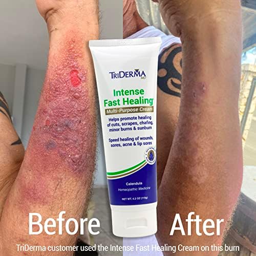 TriDerma Intense Fast Skin Healing Cream for Hard-to-Heal Skin Irritations, Sores, Rashes, Dry, Cracked Hands, Cuts, Chafing, Burns