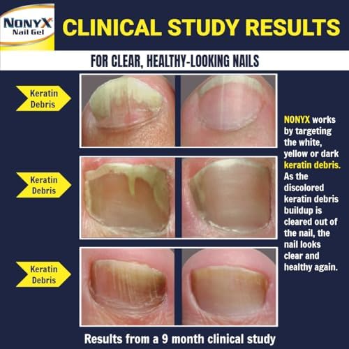 NONYX Fungal Nail Clarifying Gel | Clinically Proven for Discolored, Thick, Brittle, Yellow, Lifted