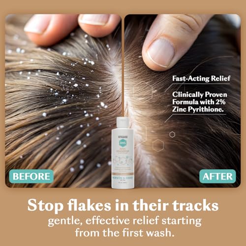 DHS Zinc Shampoo – Dandruff Shampoo – for Flaky and Dry Scalp with 2% Zinc Pyrithione, 8 oz