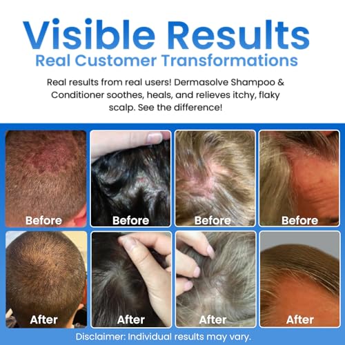 Dermasolve Psoriasis, Seborrheic Dermatitis & Dandruff Shampoo plus Conditioner. Naturally Heals Itchy Flakey Inflamed Skin and Provides Soothing Moisturizing Relief. (8.0 oz)