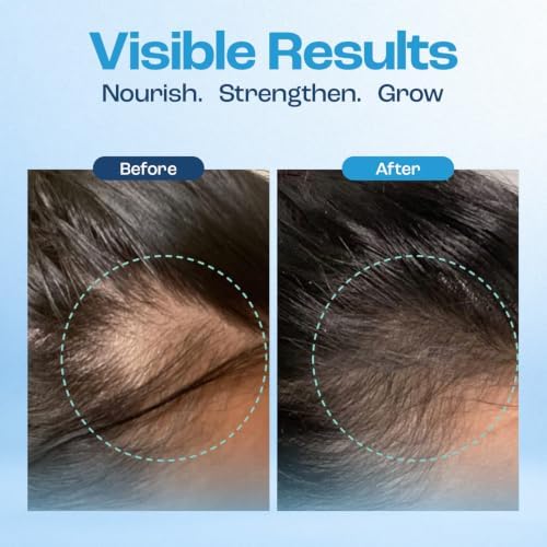 Baby Blues Postpartum Hair Loss Vitamins & Gummies for Women, Biotin & Collagen for Hair Growth Support, Thinning Hair Support
