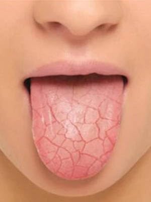 dry mouth tabs, dry mouth relief, dry mouth remedy, biotene, throat lozenges, best dry mouth
