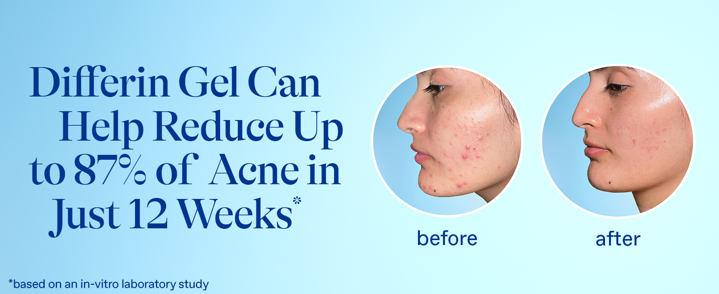 Differin gel helps reduce up to 87% of acne in 12 weeks
