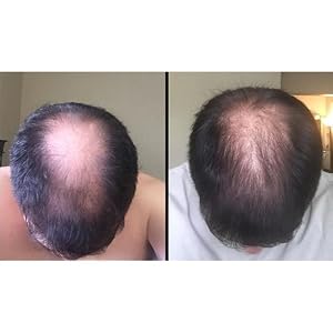 Hair loss growth regrowth dht blocker block thin thinning stimulate viviscal propidren