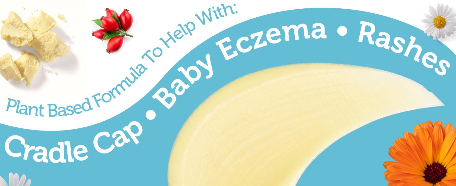 Module 4 - Image.png Cradle Cap - Baby Eczema - Rashes