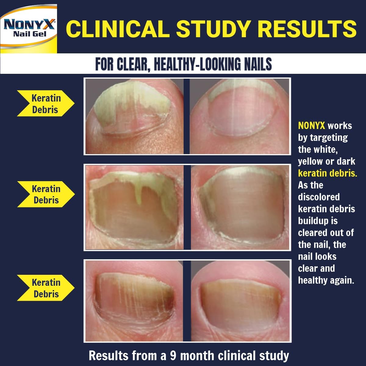 NONYX Fungal Nail Clarifying Gel | Clinically Proven for Discolored, Thick, Brittle, Yellow, Lifted