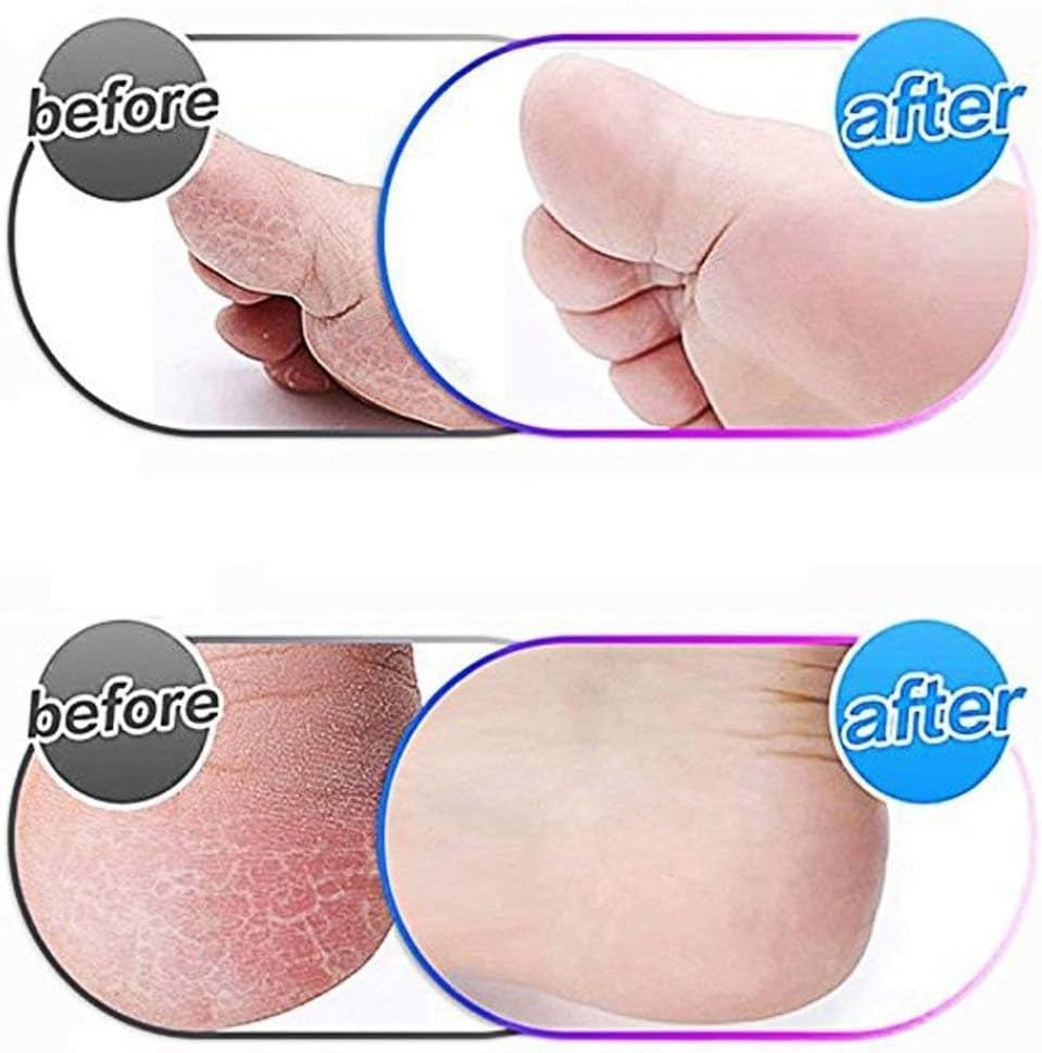 10 Pack Extra Coarse Replacement Rollers for Amope Pedi Refills Electronic Perfect Foot File Pedi Hard Skin Remover Refills
